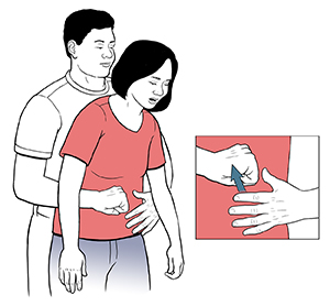 Choking: First Aid and Prevention
