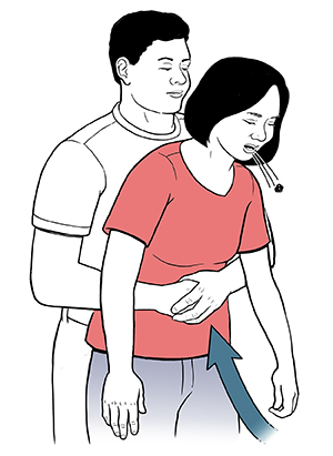 Choking: First Aid and Prevention