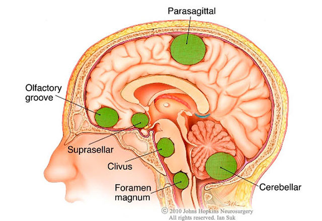 The Most Common Brain Tumor 5 Things You Should Know