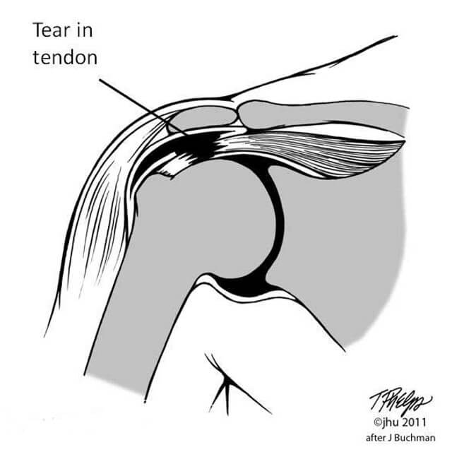 Conditions We Treat: Rotator Cuff Tears | Johns Hopkins Department of ...