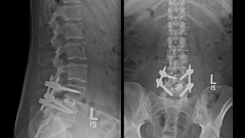 spine fusion