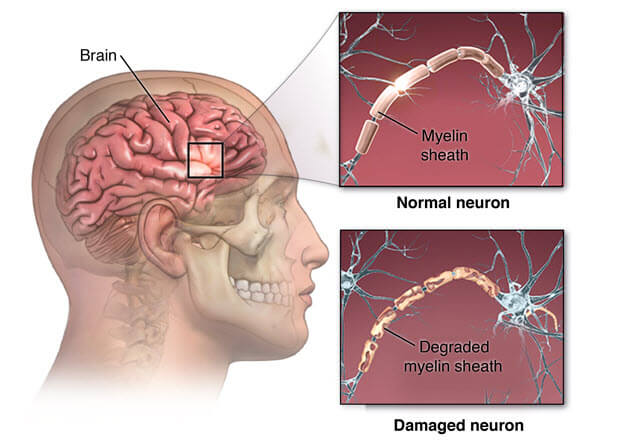 Disegno schematico dei nervi danneggiati nella SM