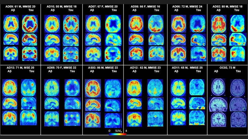 Johns Hopkins Team Promising Diagnostic For Alzheimer's Disease