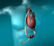 Ventricular Assist Devices