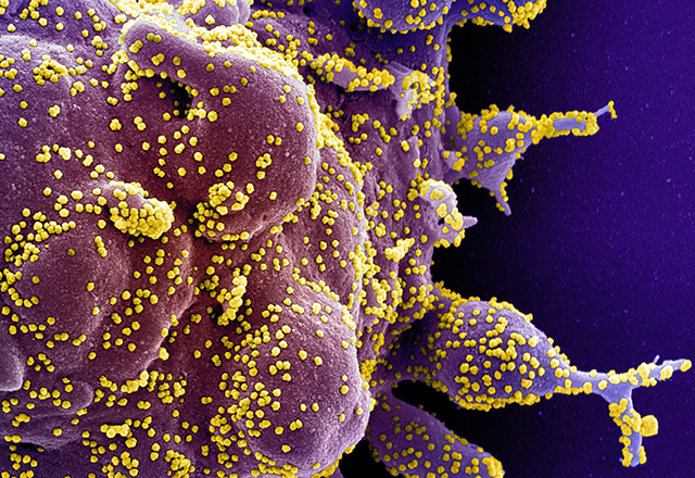 Colorized scanning electron micrograph of a cell heavily infected with SARS-CoV-2 virus particles.