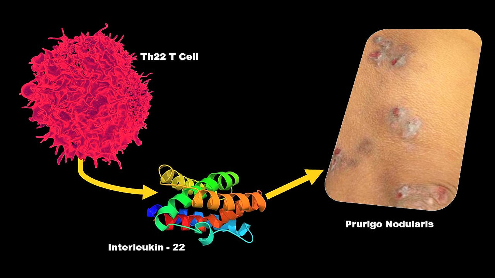 Research Story Tip Johns Hopkins Medicine Team Discovers Novel Mediator Of Once Mysterious Chronic Itch