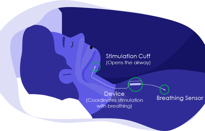 hypoglossal nerve stimulator