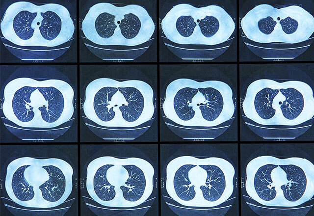 We CT Lung Screening Johns Hopkins Medical Imaging
