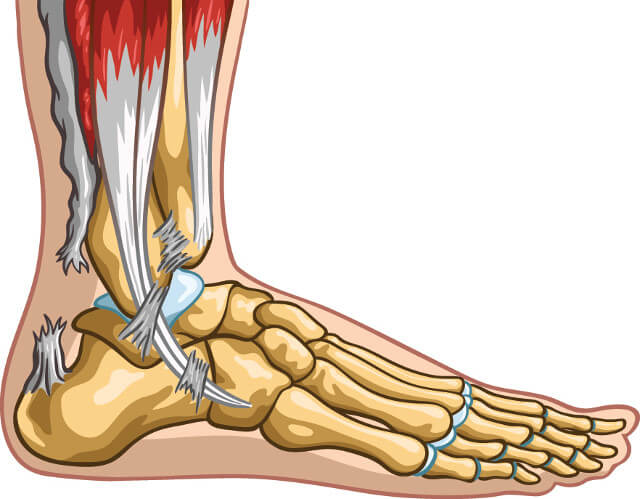 causes of torn achilles tendon